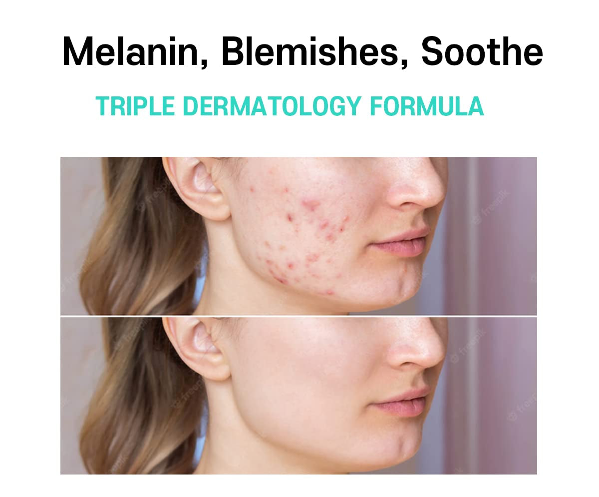 Melasma Treatment for Face Cream - Dark Spot Remover Centella Asiatica - Korean Skin Care Beauty Products 40Ml/1.35 Fl.Oz